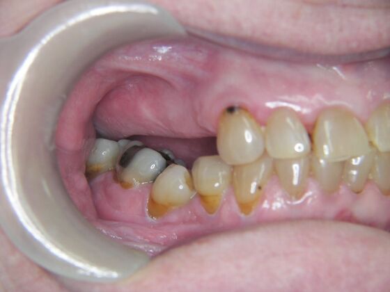 Dental Implants: Case 4 - Before