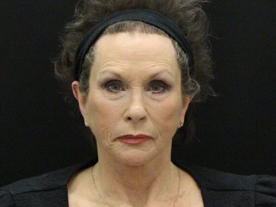 Face & Neck Lifts: Case 47 - After