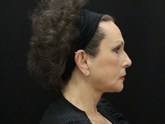 Face & Neck Lifts: Case 47 - After