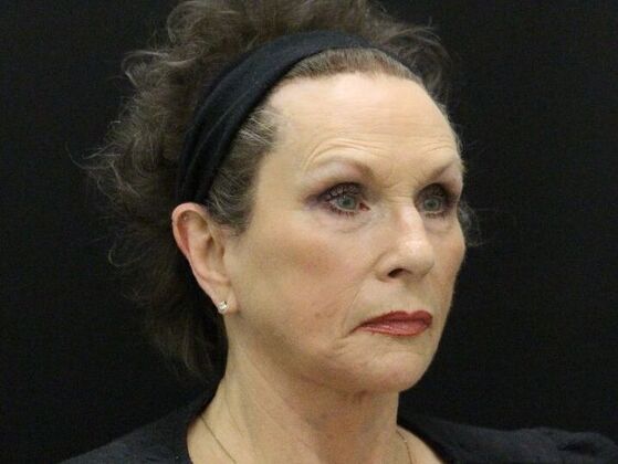 Face & Neck Lifts: Case 47 - After