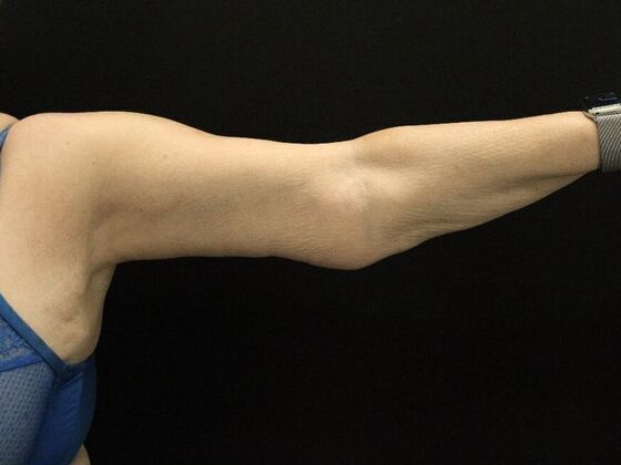 Arm Lift: Case 26 - After