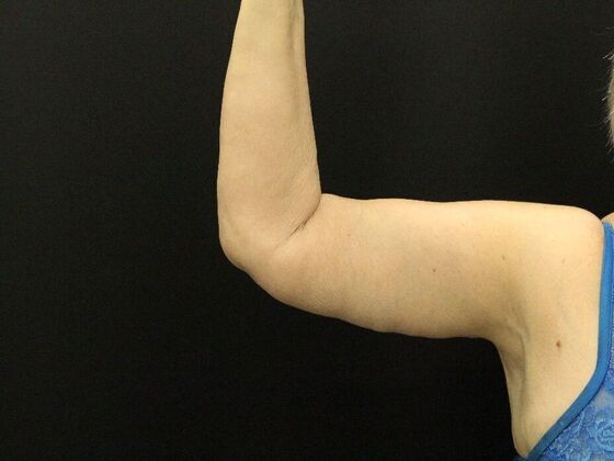 Arm Lift Case 26 - After