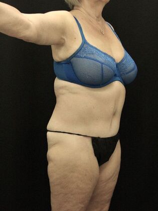 Tummy Tuck Case 78 - After