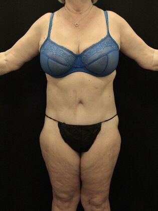 Tummy Tuck: Case 78 - After