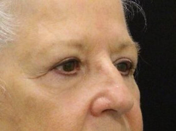 Eyelid Surgery Case 18 - After