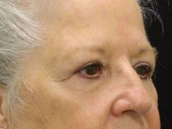 Non-Surgical: Case 13 - After