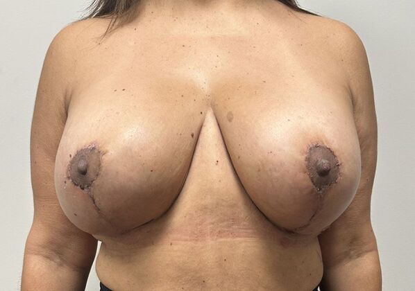 Breast Revision: Case 301 - After