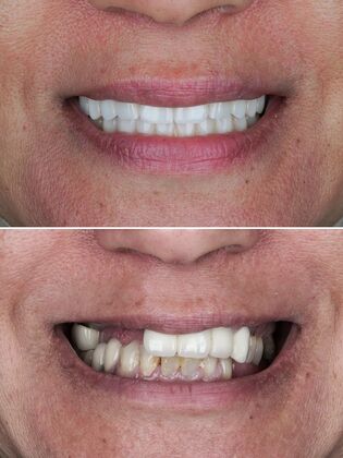 Before and After Cases