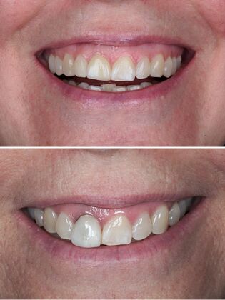 Before and After Case 4