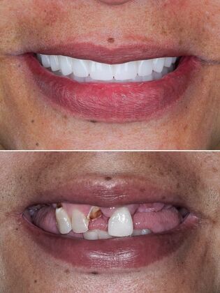 Before and After Case 5