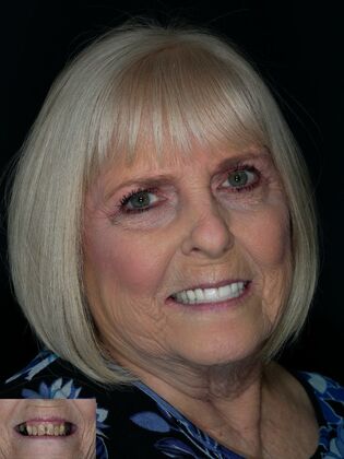 Before and After Case 13