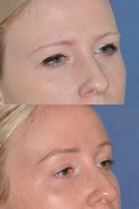 Endoscopic Browlift: Seven years after endoscopic browlift. It