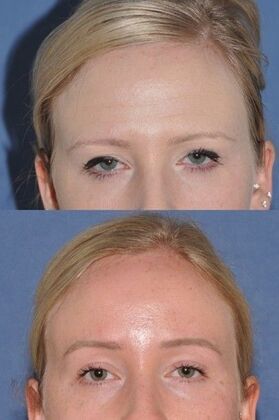Endoscopic Browlift: Seven years after endoscopic browlift. It