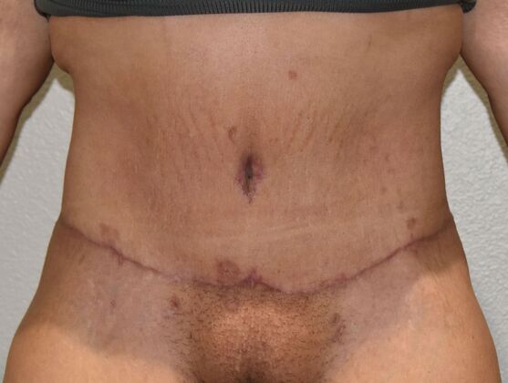 Tummy Tuck (Abdominoplasty) Case 542 - After