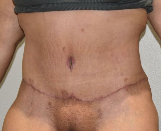 Tummy Tuck (Abdominoplasty): Case 542 - After