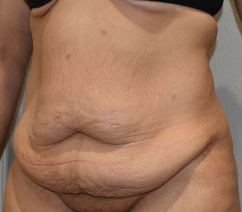 Tummy Tuck (Abdominoplasty): Case 542 - Before