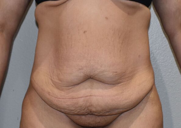 Massive Weight Loss  Case 179 - Before