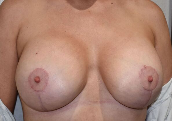 Breast Augmentation w/ Lift: Case 8 - After