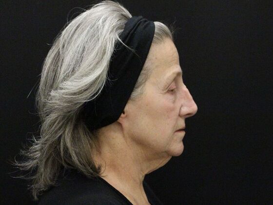 Face & Neck Lifts Case 55 - Before