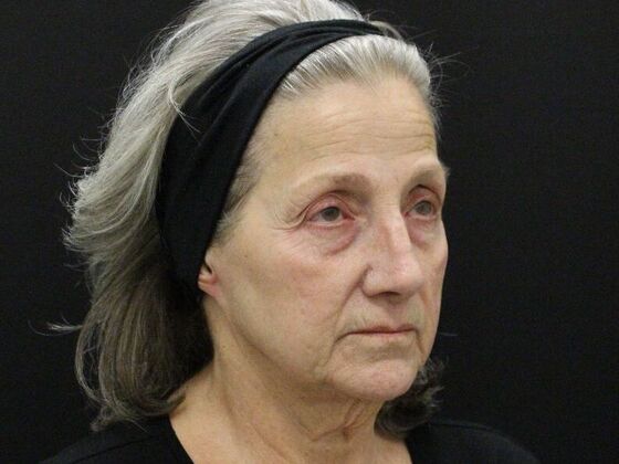 Face & Neck Lifts: Case 55 - Before