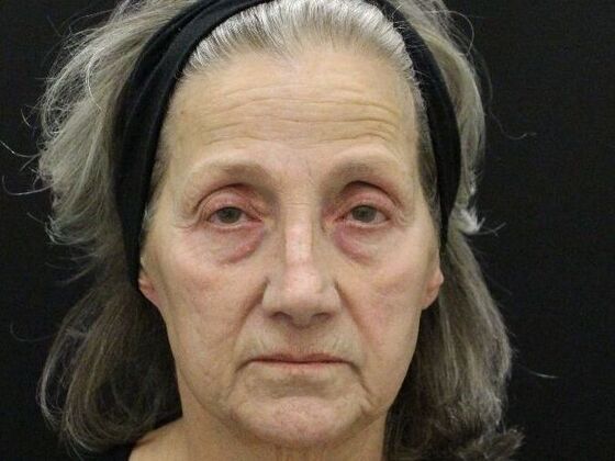 Face & Neck Lifts: Case 55 - Before