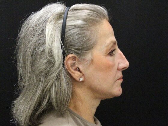 Face & Neck Lifts Case 55 - After