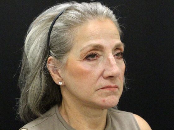 Face & Neck Lifts: Case 55 - After