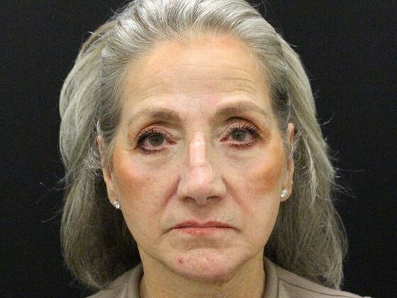 Face & Neck Lifts: Case 55 - After