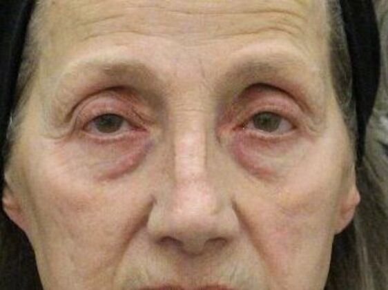 Eyelid Surgery Case 22 - Before