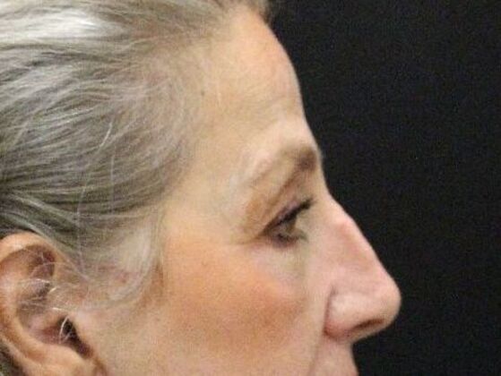 Eyelid Surgery: Case 22 - After