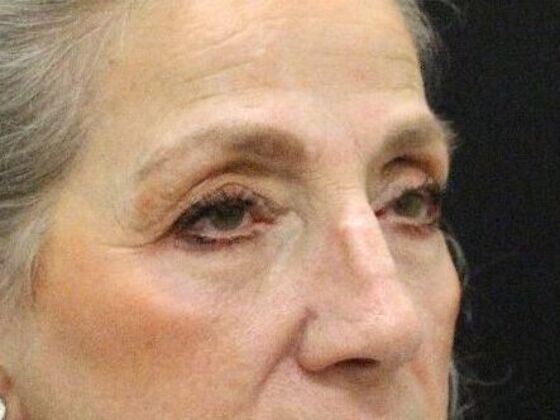 Eyelid Surgery: Case 22 - After