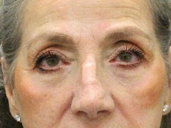 Eyelid Surgery Case 22 - After