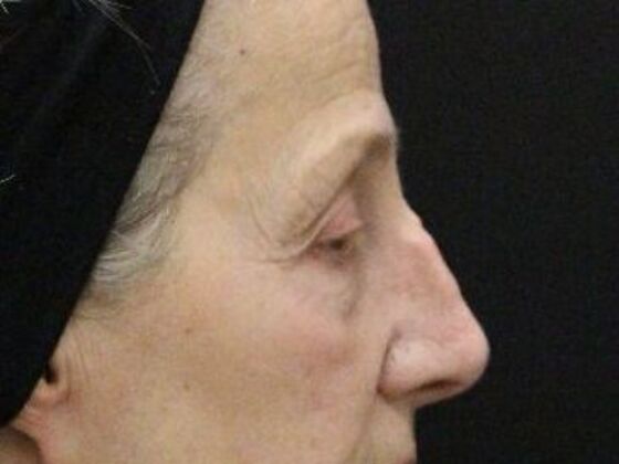 Eyelid Surgery: Case 22 - Before