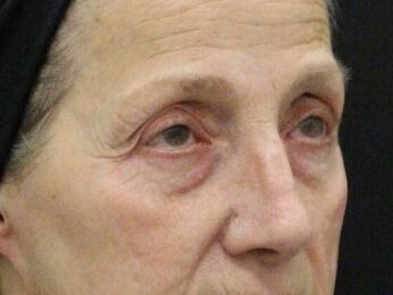 Eyelid Surgery: Case 22 - Before