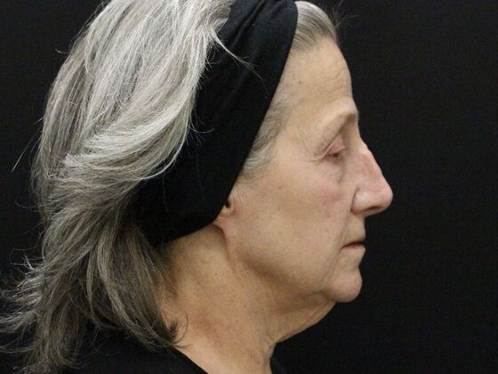 Non-Surgical: Case 16 - Before