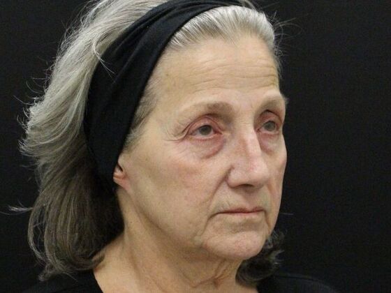 Non-Surgical: Case 16 - Before