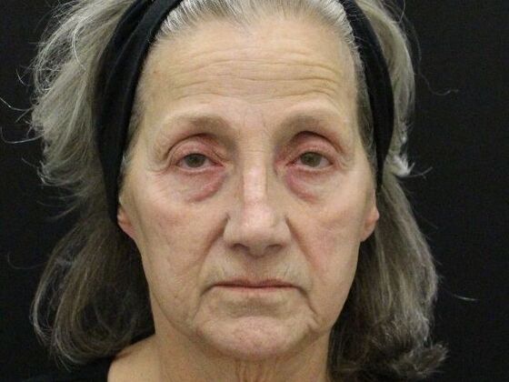 Non-Surgical: Case 16 - Before