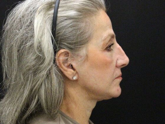 Non-Surgical: Case 16 - After