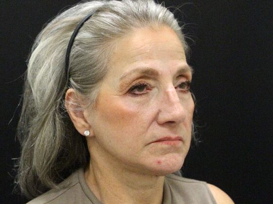 Non-Surgical: Case 16 - After