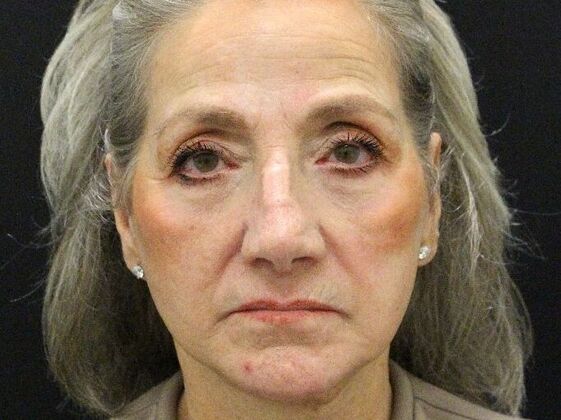 Non-Surgical: Case 16 - Before