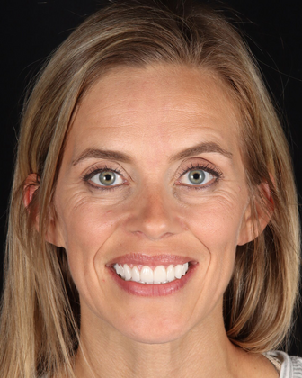 Full Mouth Reconstruction Cases