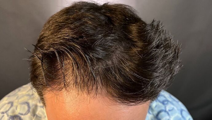 FUE Hair Restoration: Case 50 - Before