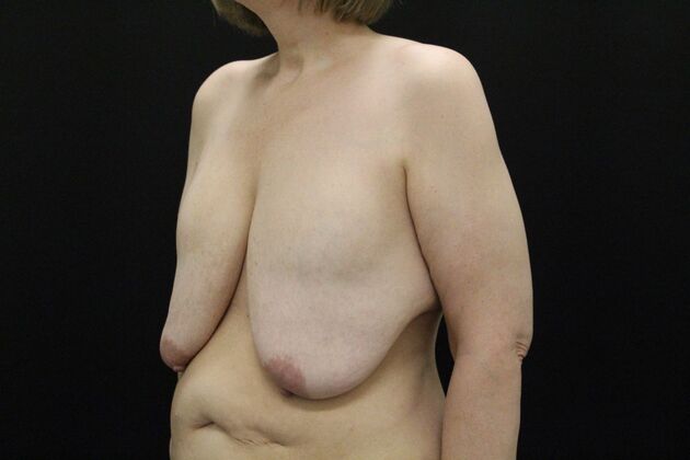 Breast Revision: Case 17 - Before