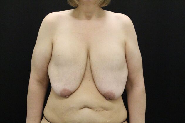 Breast Revision Case 17 - Before