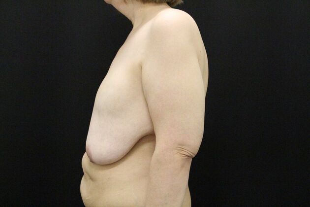 Breast Lift & Breast Lift Augmentation: Case 55 - Before