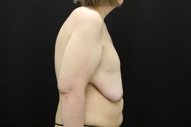 Breast Lift & Breast Lift Augmentation: Case 55 - Before