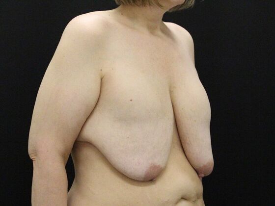 Breast Lift & Breast Lift Augmentation: Case 55 - Before