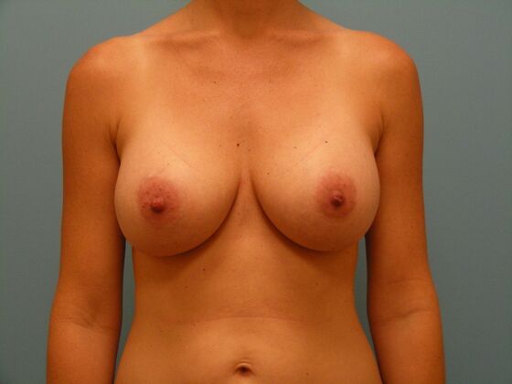 Breast Augmentation High Profile Memory Gel Implants - Breast Augmentation - Chandler, AZ - After
