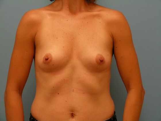 Breast Augmentation High Profile Allergan Implants - Breast Augmentation - Gilbert, AZ - Before