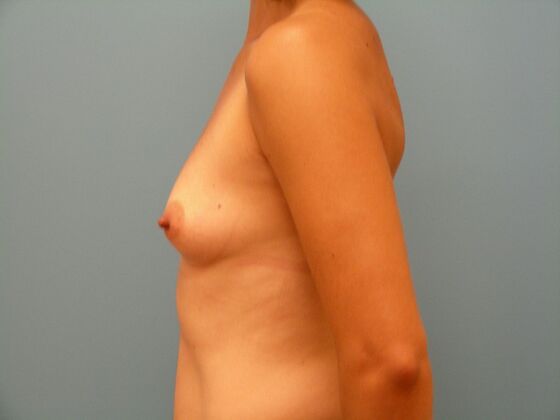 Breast Augmentation: High Profile Allergan Implants - Breast Augmentation - Gilbert, AZ - Before